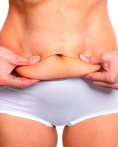 Tummy tuck