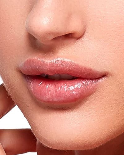 Lip Augmentation