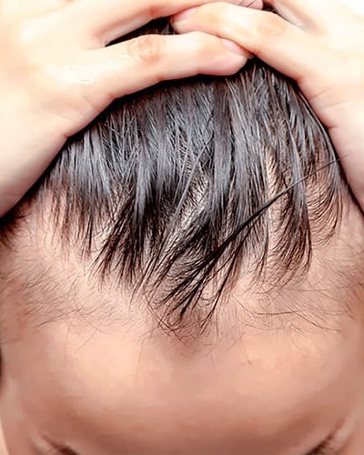 Hair transplant