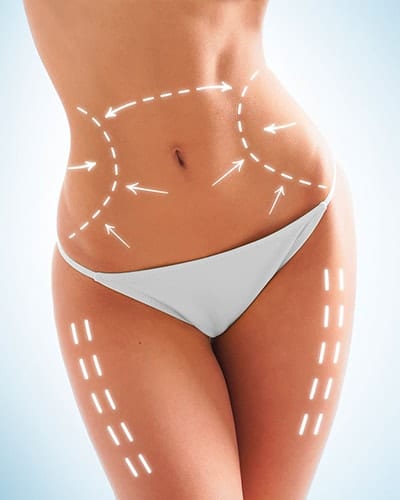 Liposculpture