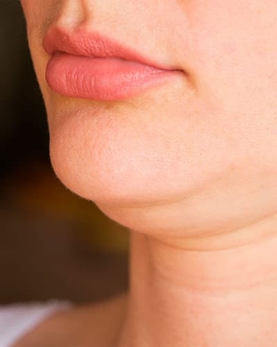 Chin liposuction