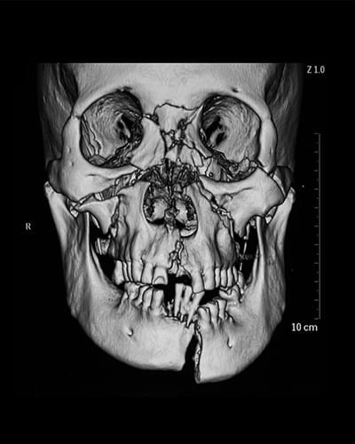 Fracturas de cara